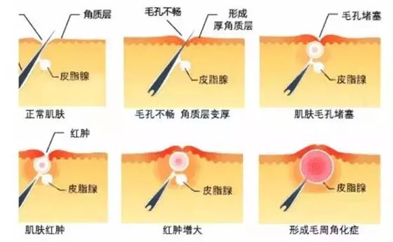 人為什么會起雞皮疙瘩